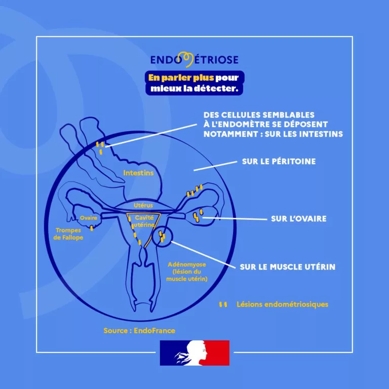 #Endométriose | L&rsquo;endométriose est une maladie inflammatoire qui peut être chronique et qui toucherait 1 femme sur 10 en… 